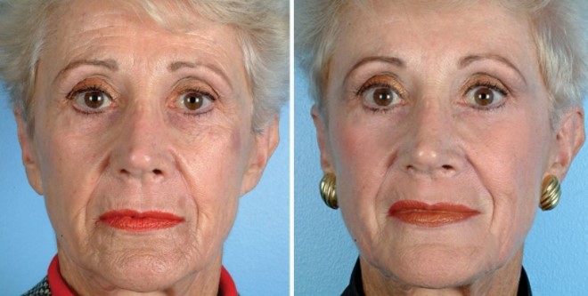 Результаты алмазного пилинга: До и После