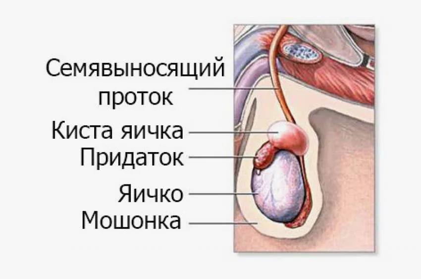 Удаление кисты придатка яичка