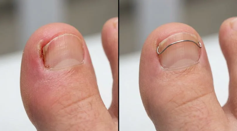 При каких состояниях ногтя устанавливают титановую пластину